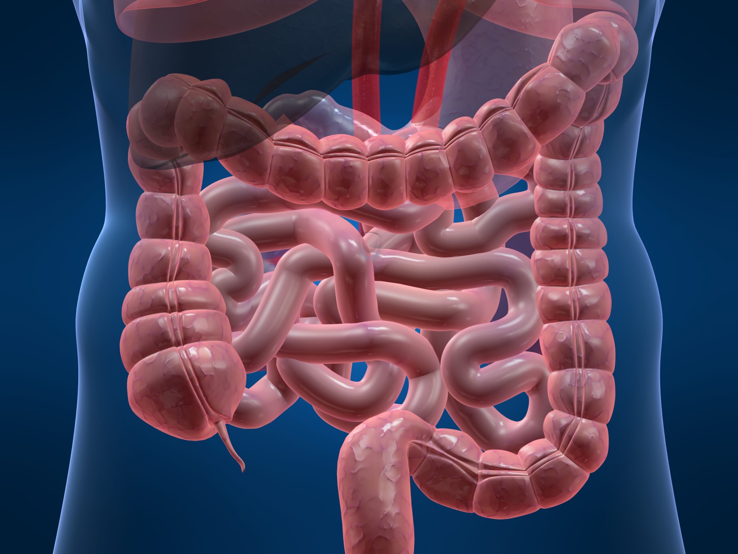 Endometriose Intestinal